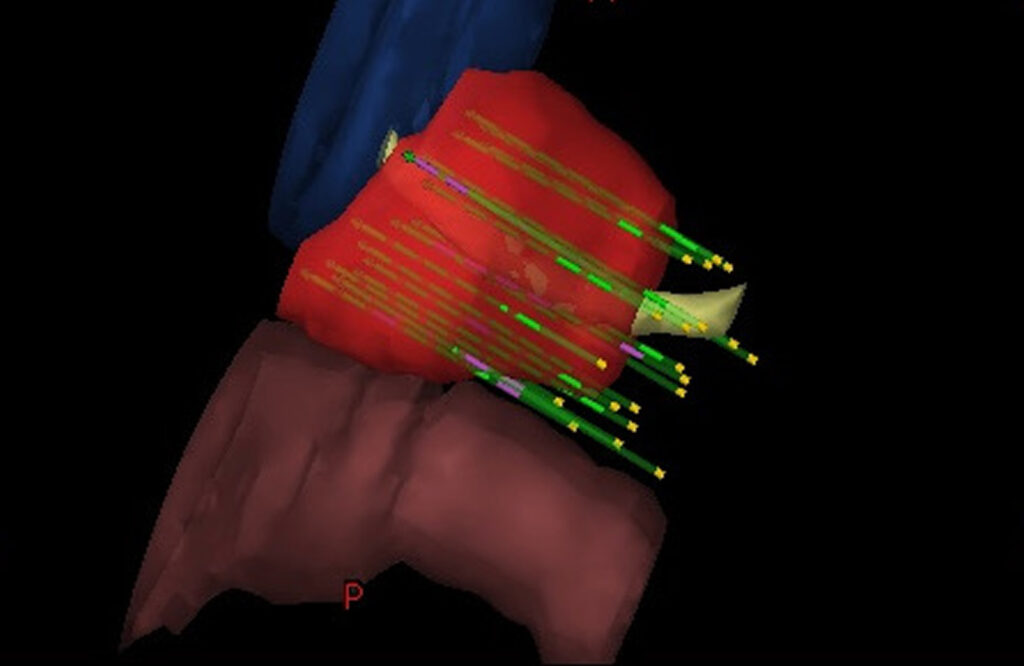 3-D model of a HDR prostate brachytherapy implant